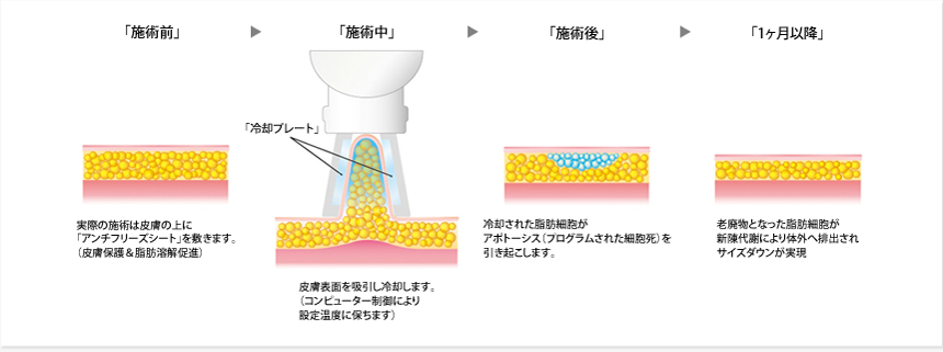 クライオリポライシスのイメージ図