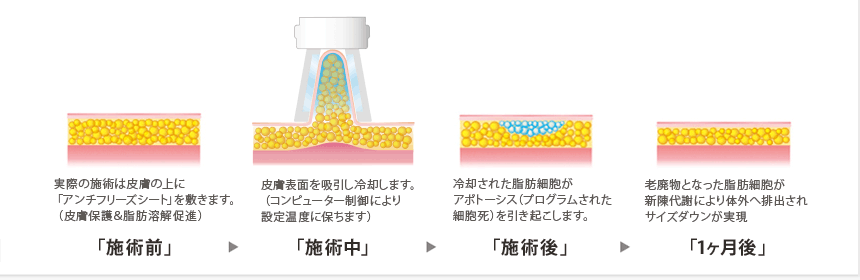 クライオリポライシスのイメージ図